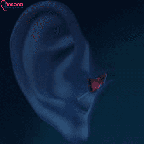 Signia Kit Silk C&G 1IX view 2